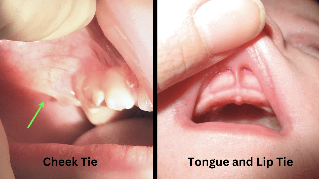 Cheek_Tie_Baby_vs_Tongue_and_Lip_Tie_Whats_the_Difference