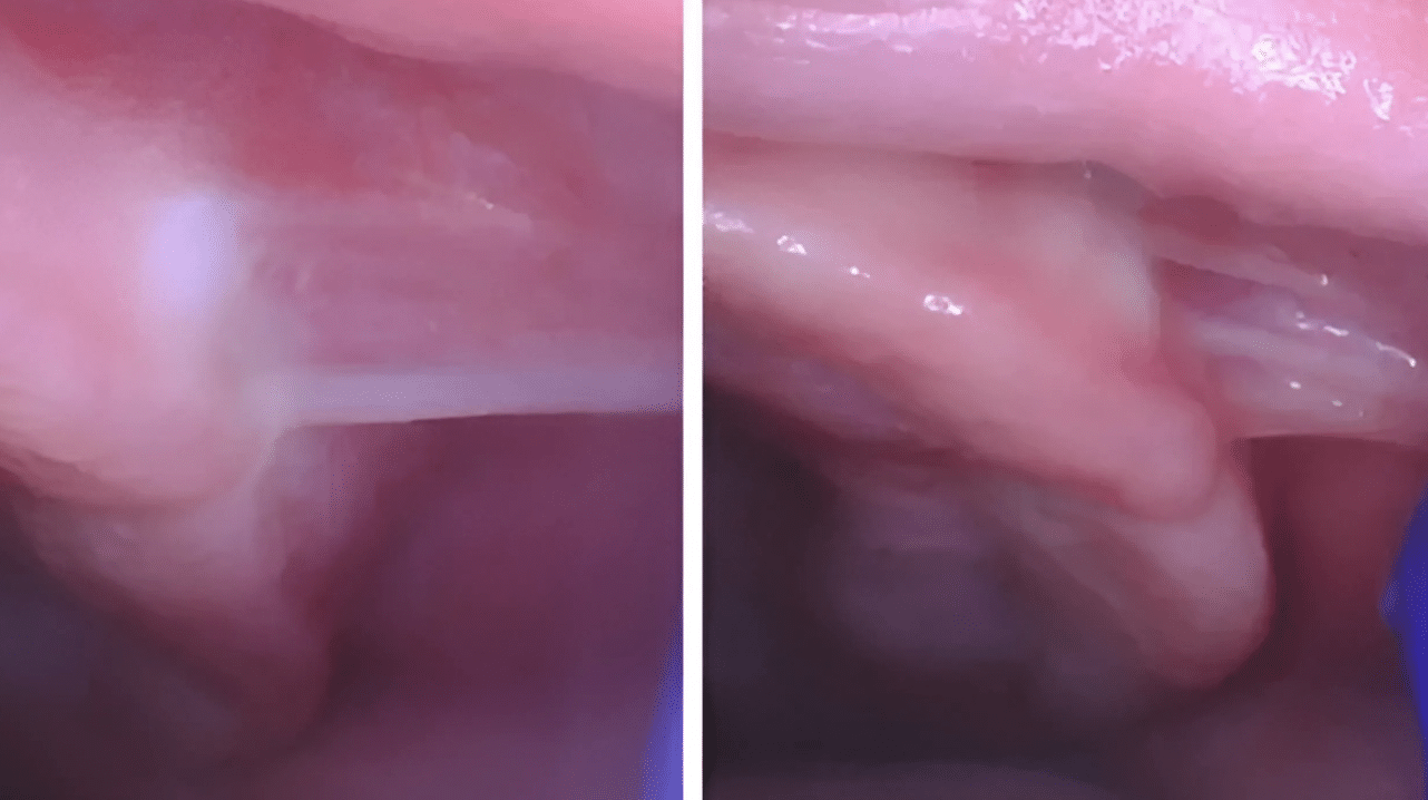 Cheek_Ties_in_Babies_What_Parents_Should_Know