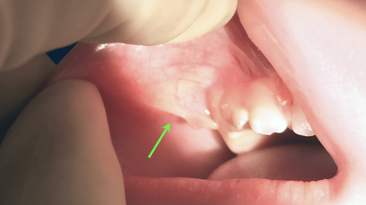 Environmental_factors_during_pregnancy_including_certain_medications_or_nutritional_deficiencies_may_also_contribute_to_their_formation