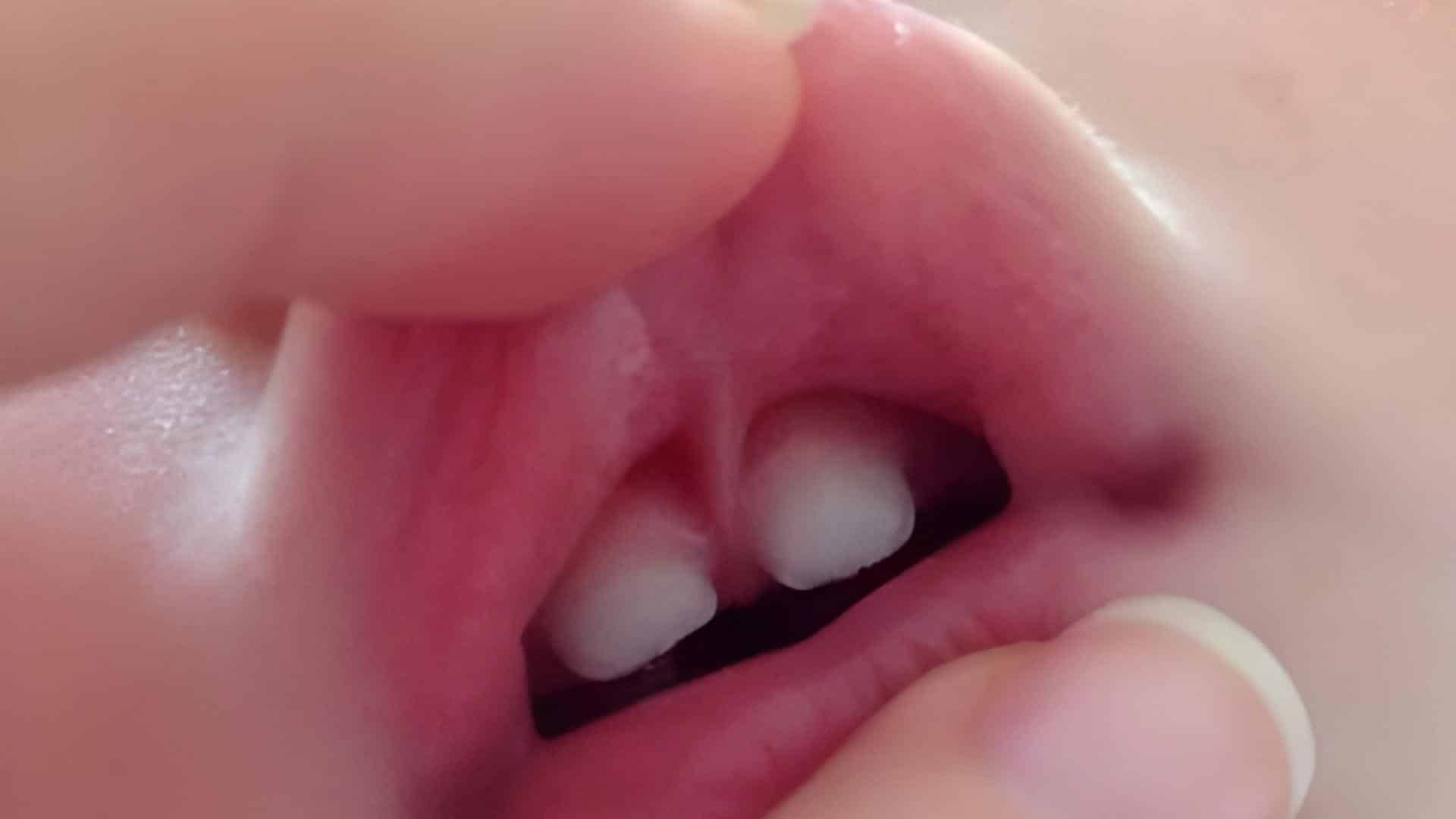 Is_Lip_Tie_Very_Serious