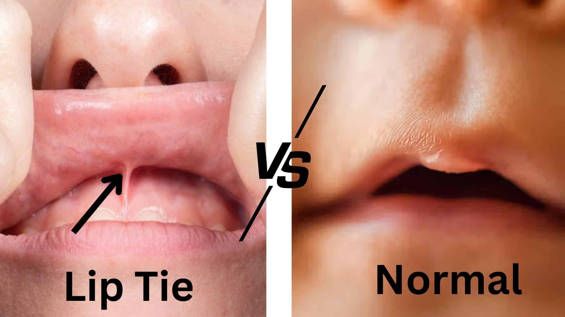 Lip_Tie_vs_Normal_Key_Differences