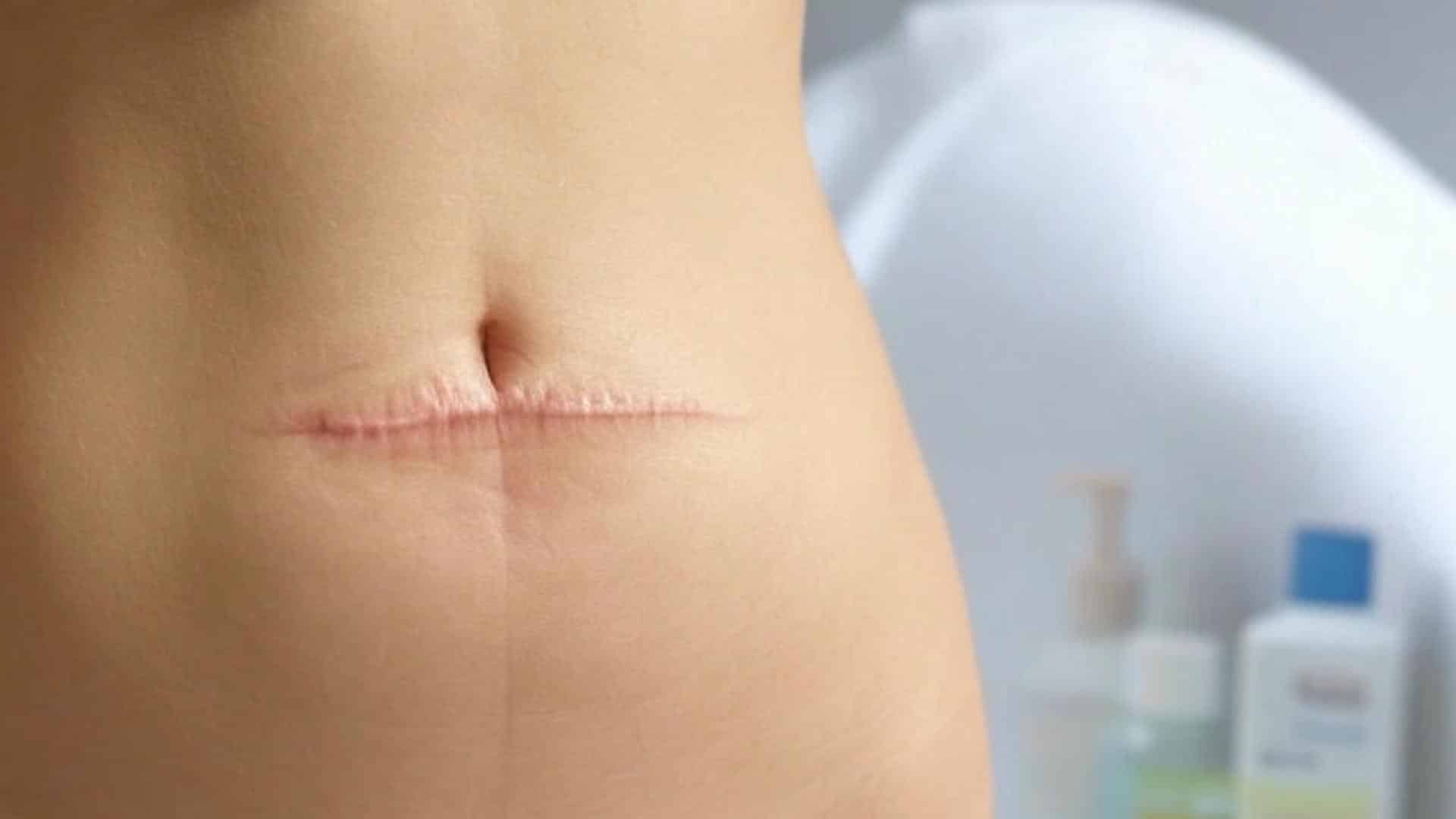 Stage_3_Remodeling_Stage_6_Weeks_to_1_Year