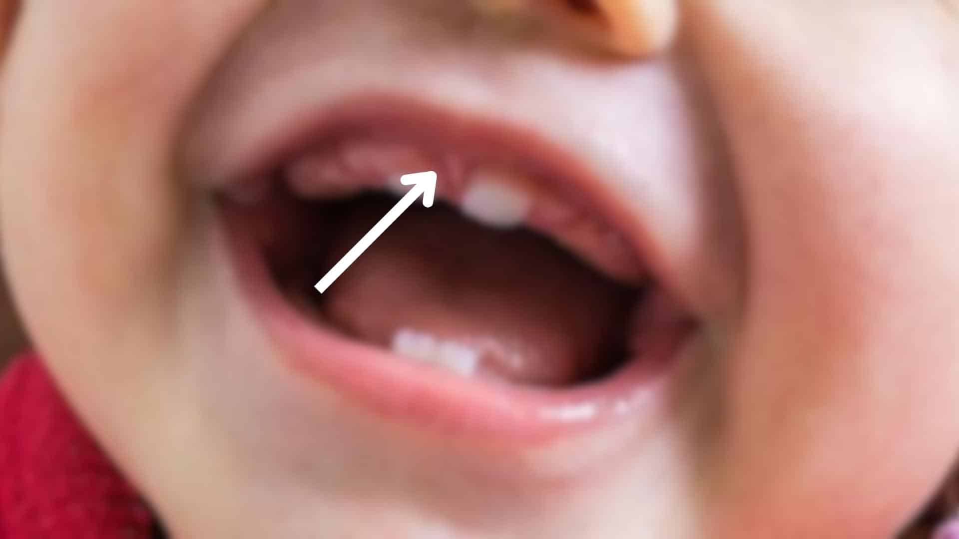 Why_Does_Lip_Tie_Happen_In_Babies