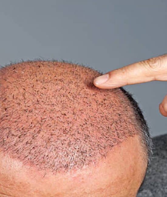 The Future of Hair Transplant: Asli Tarcan Clinic Launches Sagittal-Oblique Channel Method
