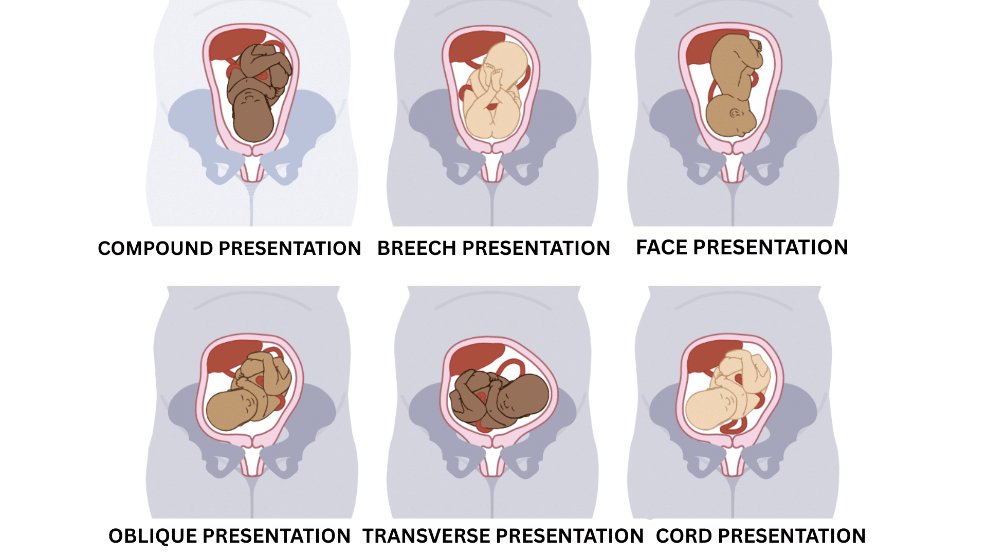 Types_of_Fetal_Malpresentation_During_Birth