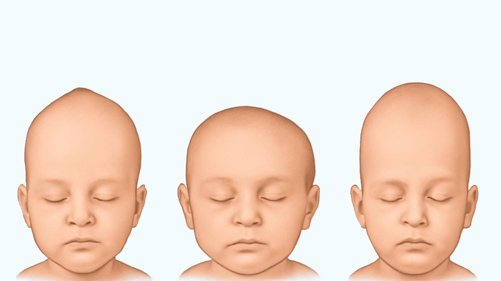 Primary_Causes_of_Abnormal_Head_Shapes