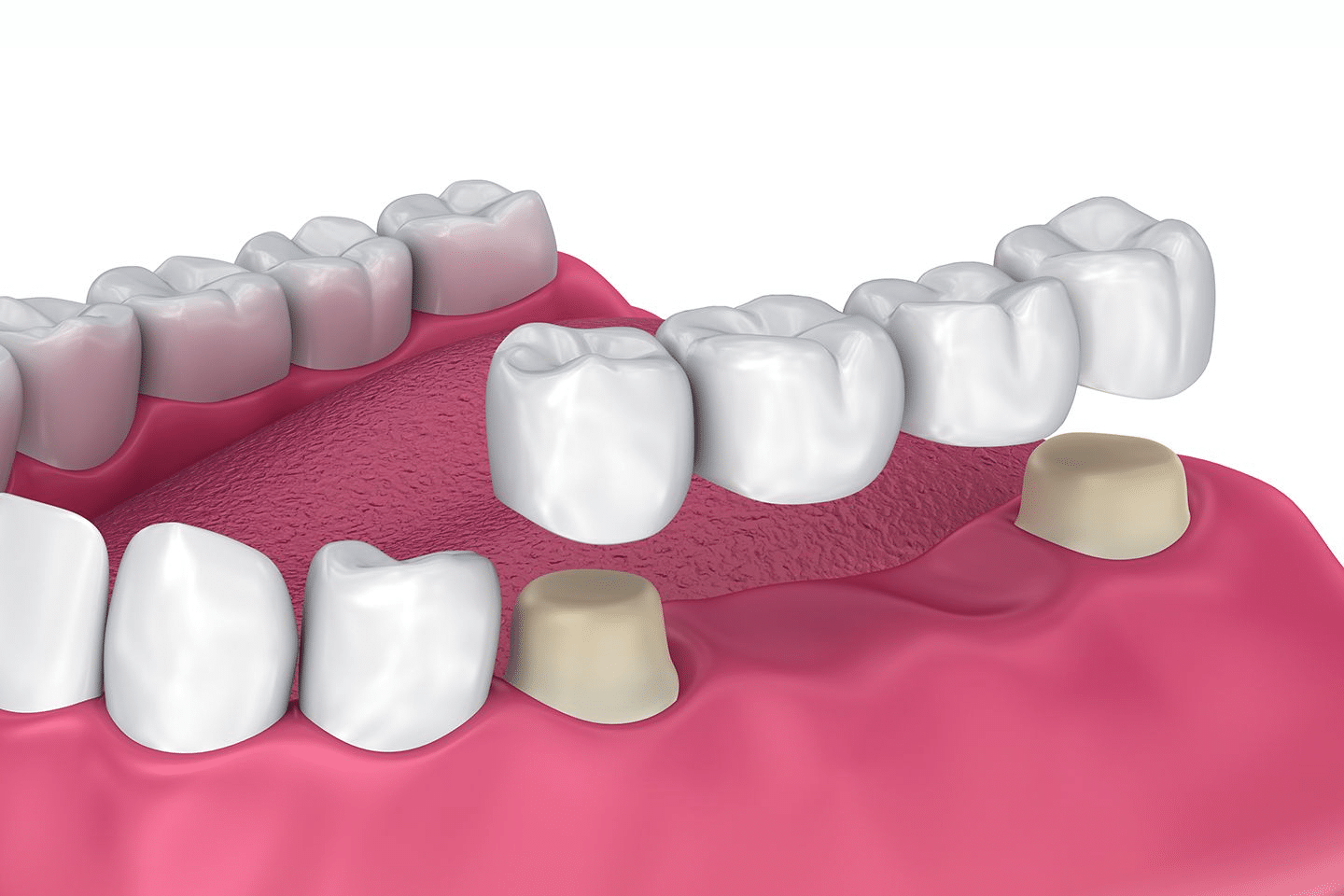 Is a Dental Bridge Ideal for You?