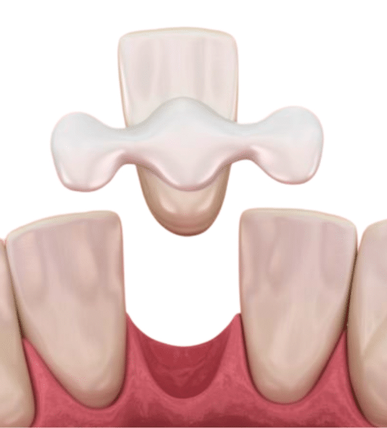 Dental Bridge