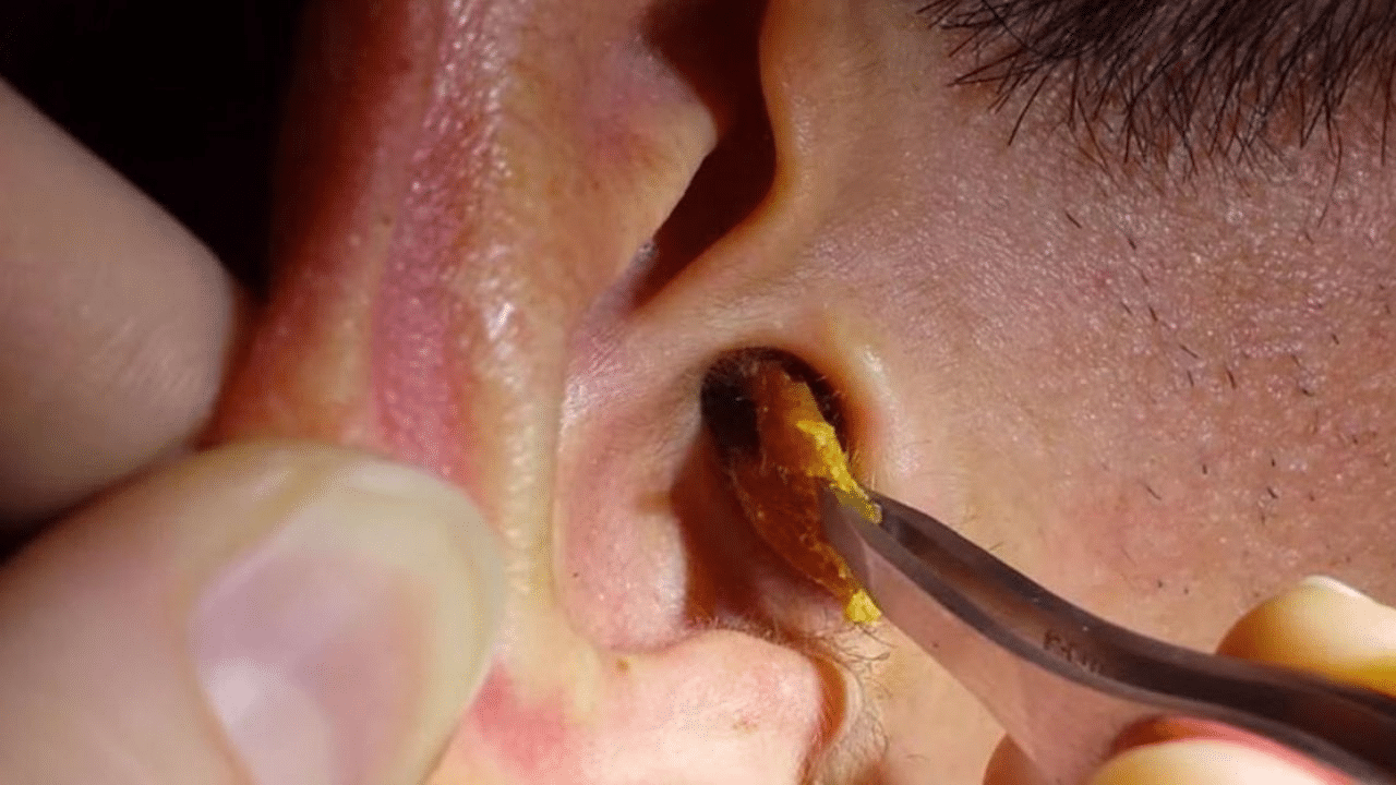 Professional Methods for Earwax Removal
