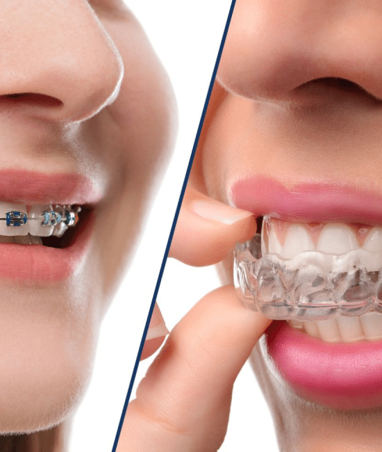 Braces vs. Aligners