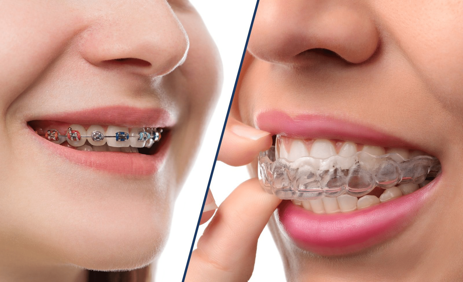 Braces vs. Aligners