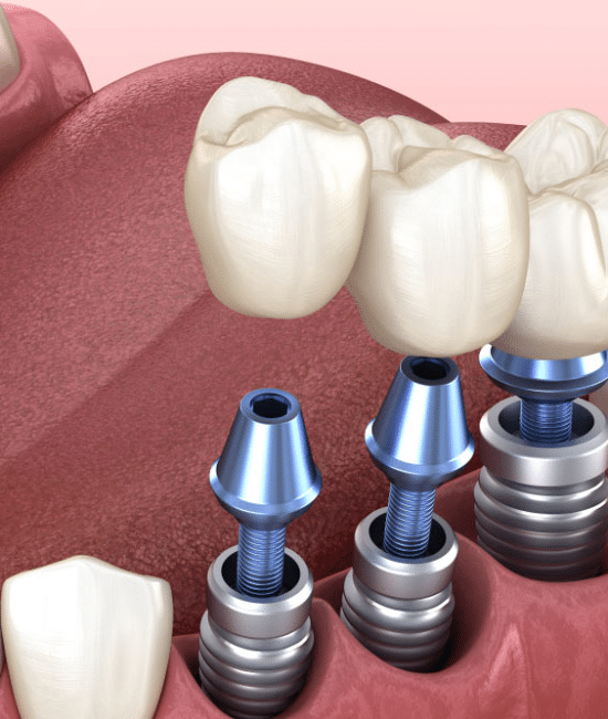 Dental Implant