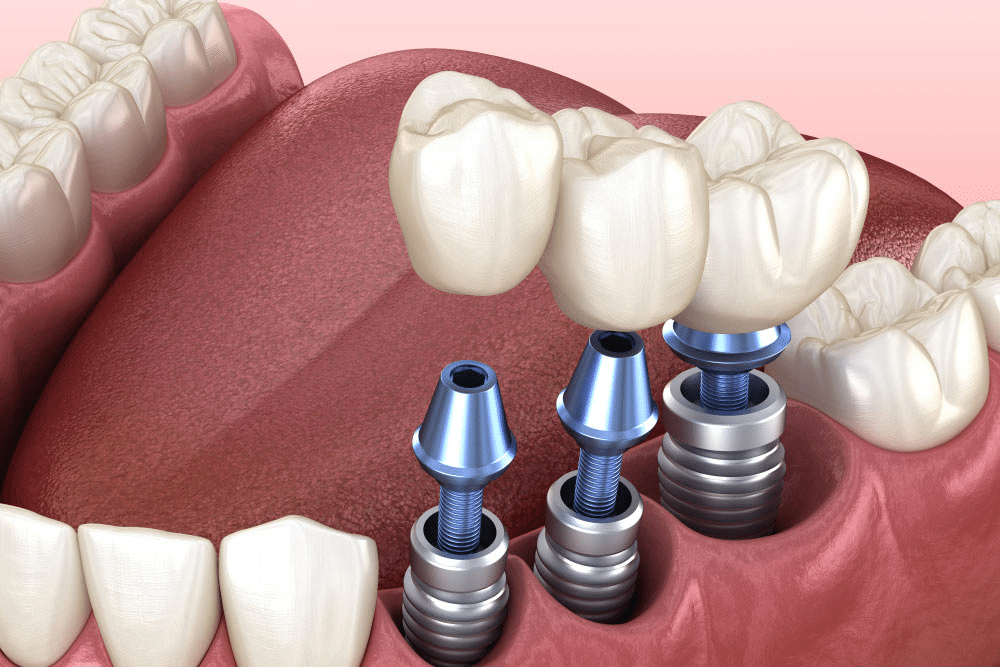 Dental Implant
