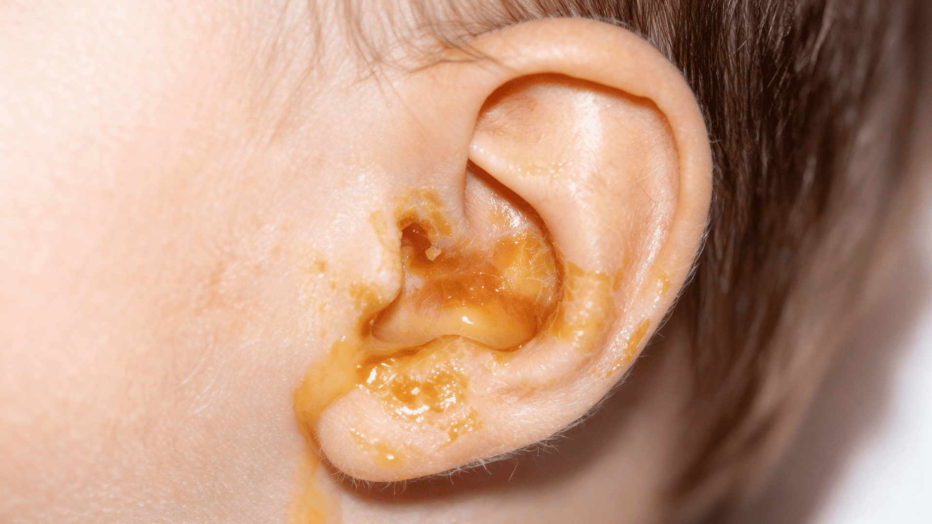 Understanding Ear Infections in Children