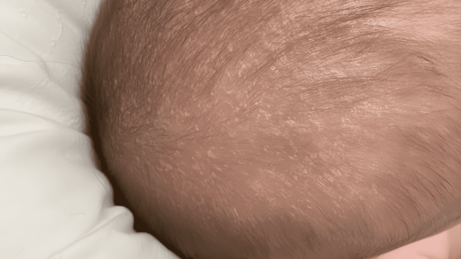 What Is a Dry Scalp in Babies?
