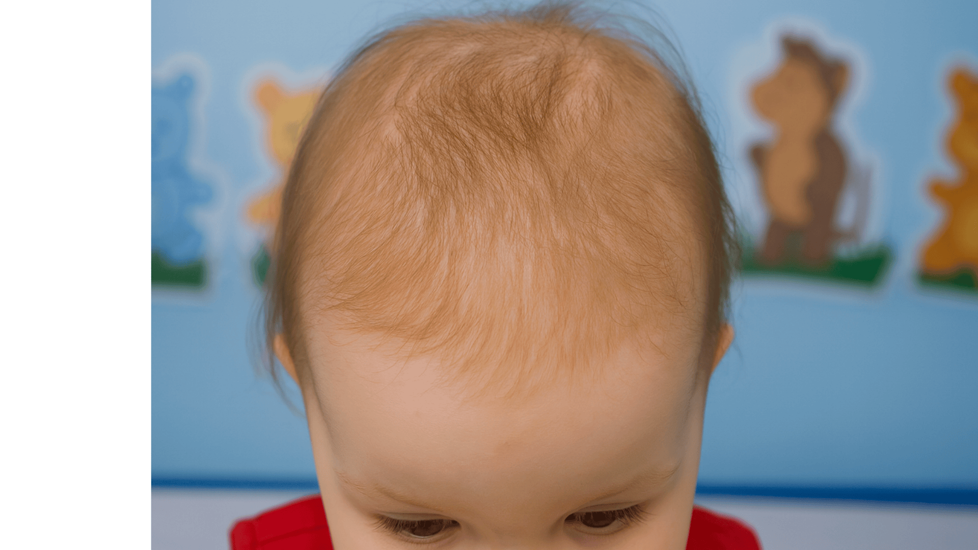 why babies lose their hair after birth