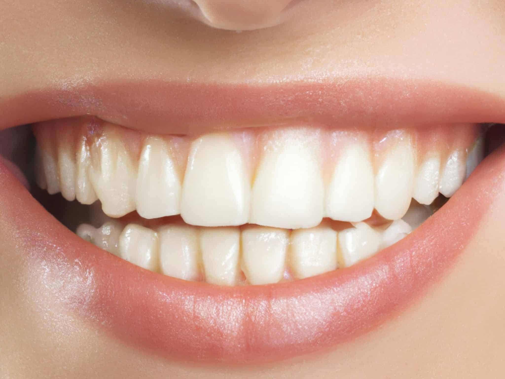 At-Home Kits vs. Professional Whitening